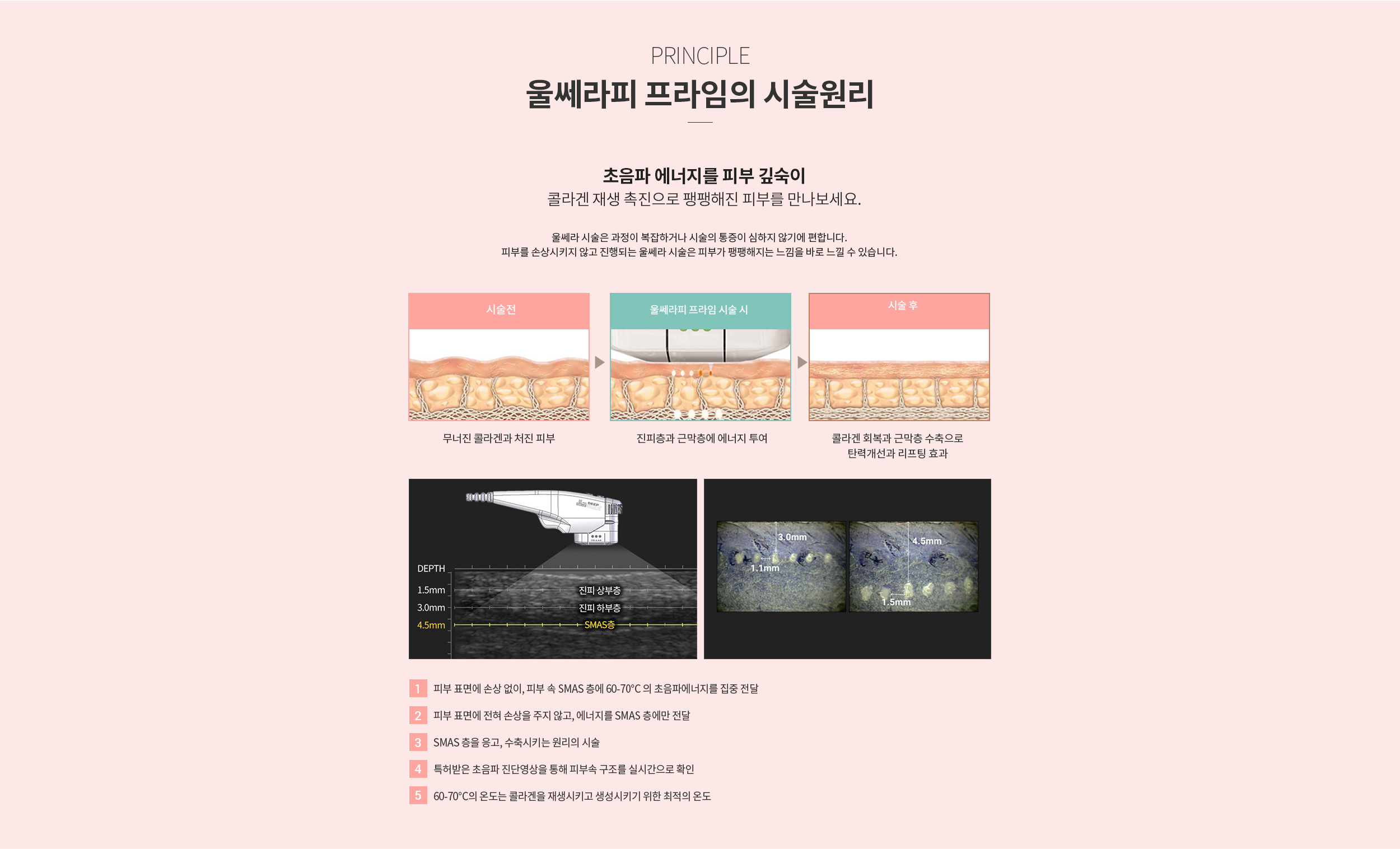 울쎄라피 프라임 시술원리